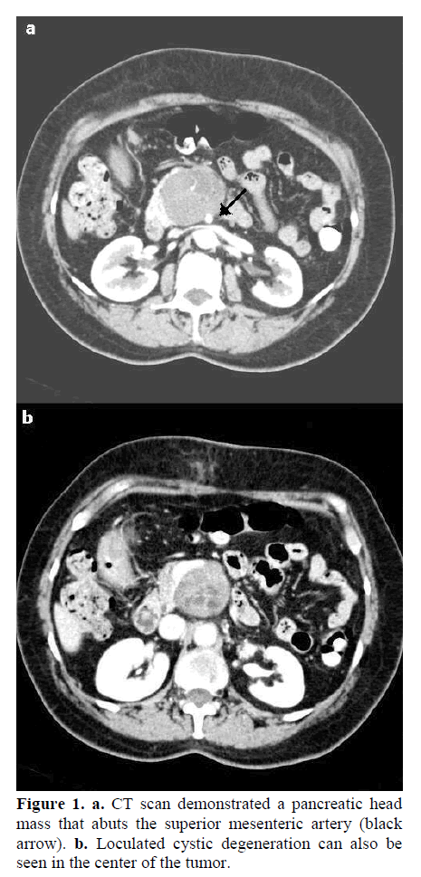 pancreas-superior-mesenteric-artery