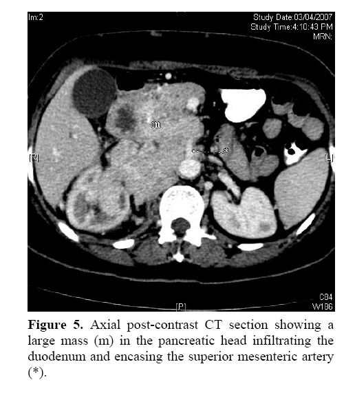pancreas-superior-mesenteric-artery