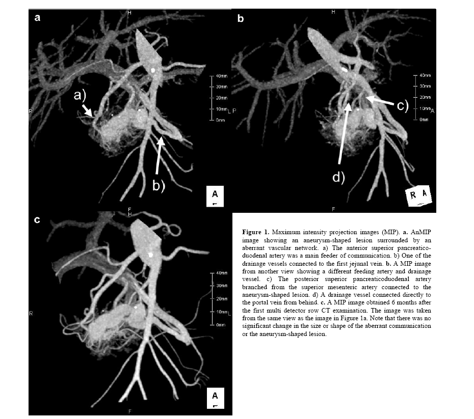 pancreas-superior-pancreaticoduodenal