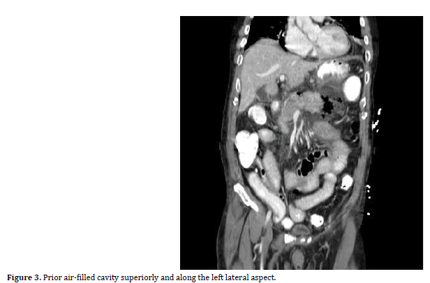 pancreas-superiorly