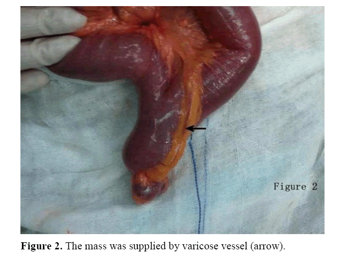 pancreas-supplied-varicose-vessel