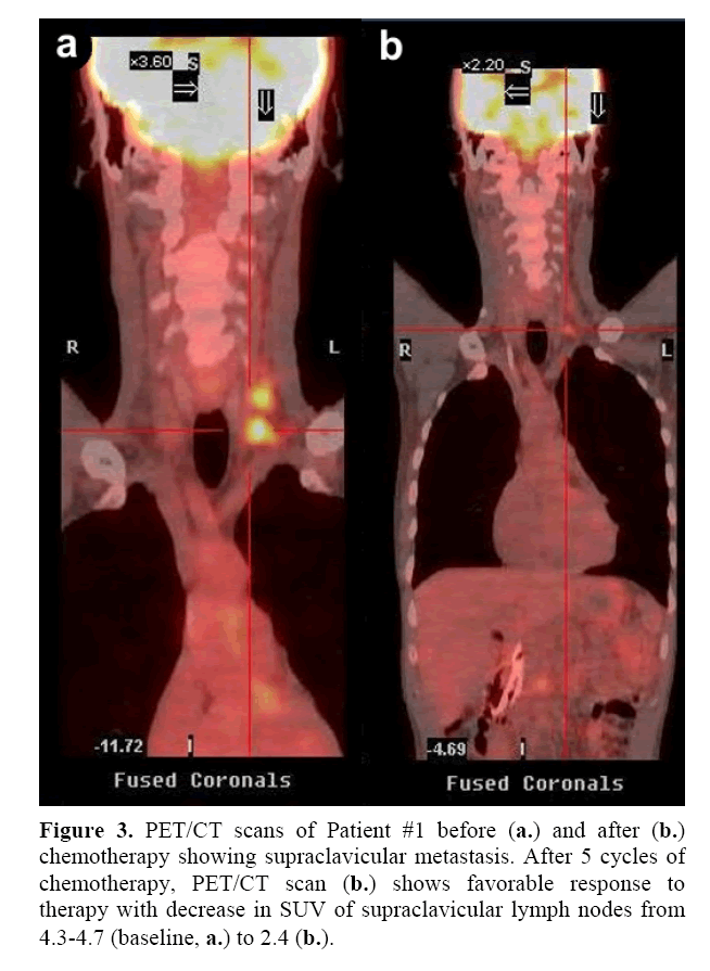 pancreas-supraclavicular-lymph-nodes