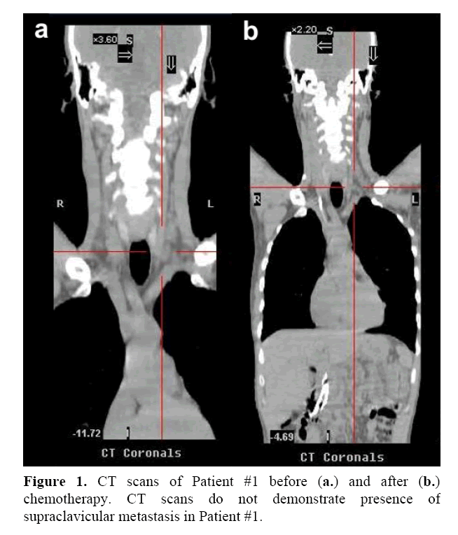 pancreas-supraclavicular-metastasis