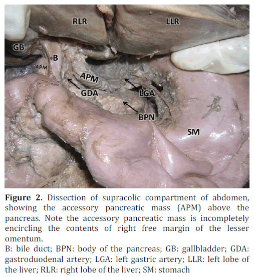 pancreas-supracolic-abdomen-pancreatic