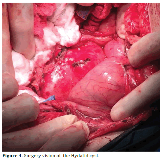 pancreas-surgery-vision-hydatid-cyst