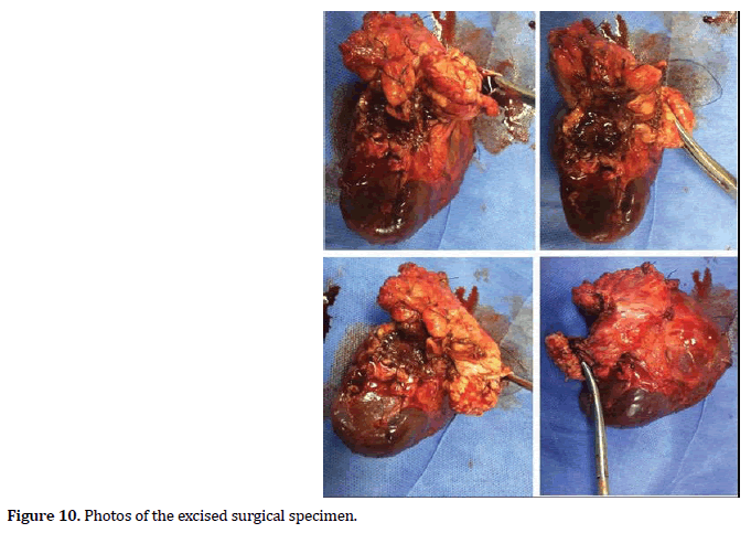 pancreas-surgical-specimen