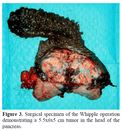 pancreas-surgical-specimen-Whipple