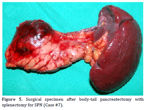 pancreas-surgical-specimen-body-tail