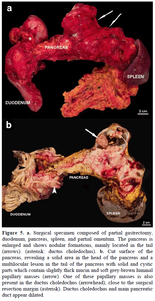 pancreas-surgical-specimen-composed-partial