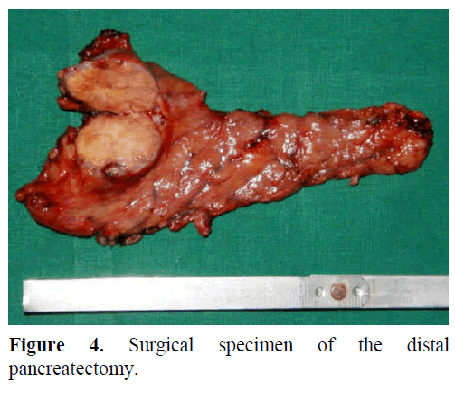 pancreas-surgical-specimen-pancreatectomy