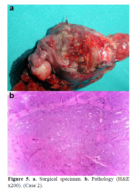 pancreas-surgical-specimen-pathology