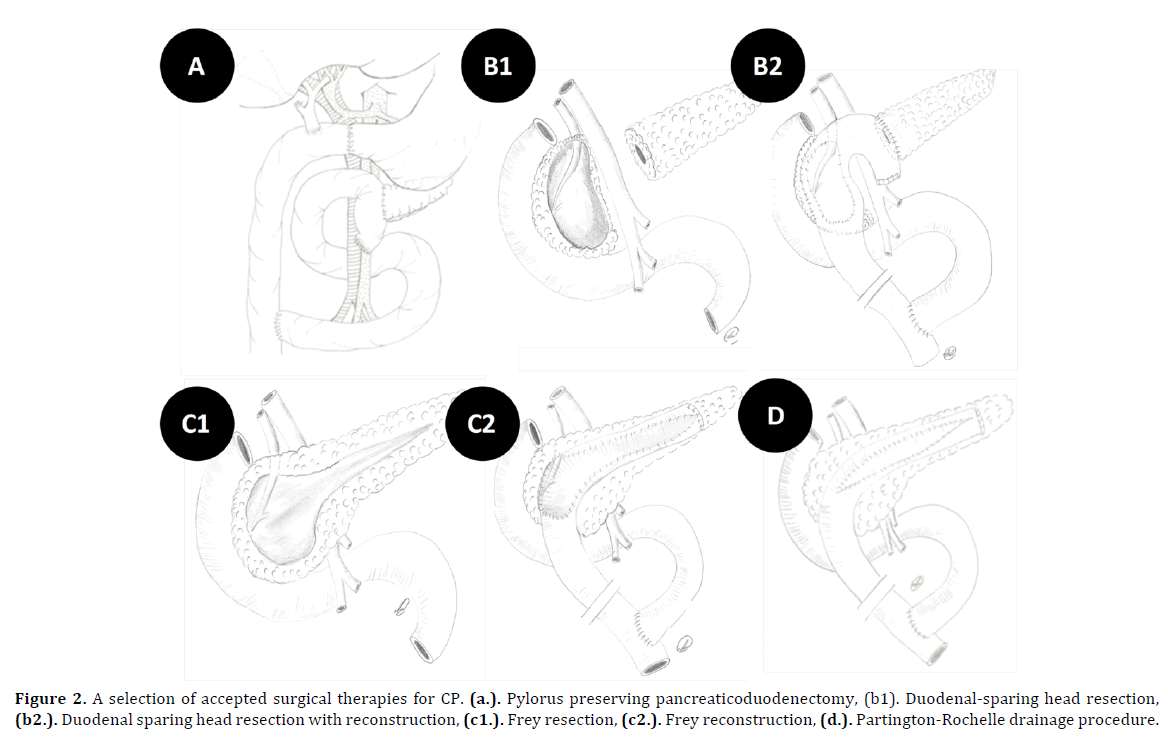 pancreas-surgical-therapies