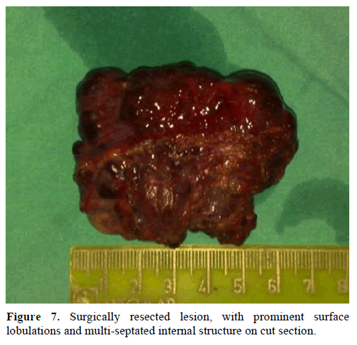 pancreas-surgically-resected-lesion-surface