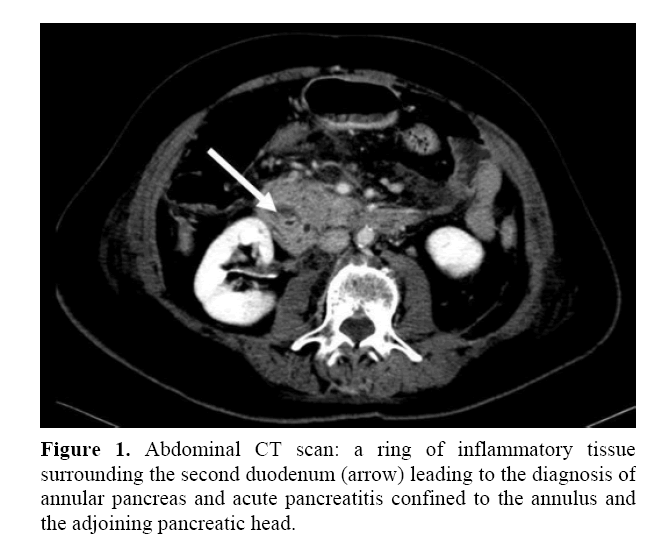 pancreas-surrounding-second-duodenum