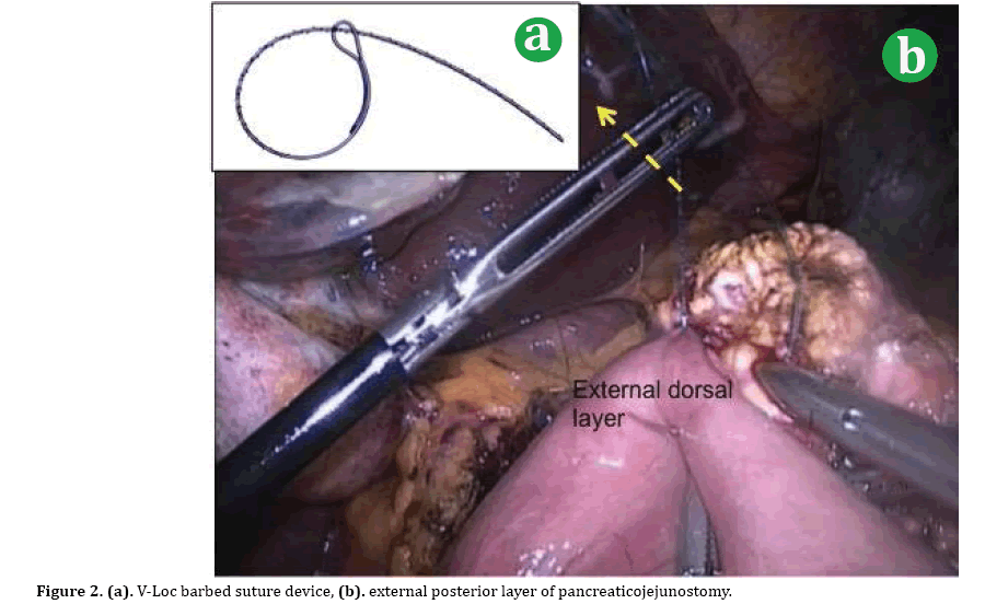 pancreas-suture