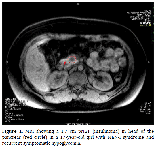 pancreas-symptomatic-hypoglycemia