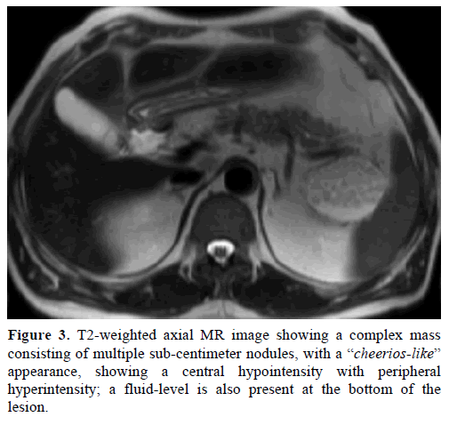 pancreas-t2-weighted-axial-mr-image