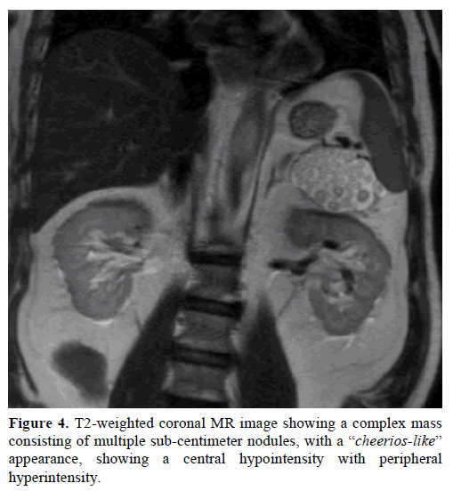 pancreas-t2-weighted-coronal-mr-image