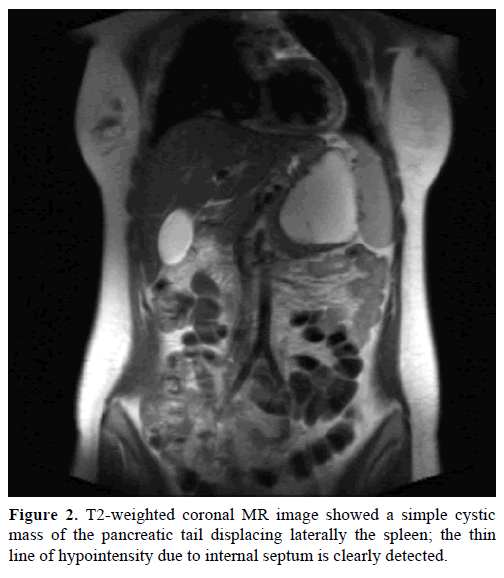 pancreas-t2-weighted-coronal-simple-cystic