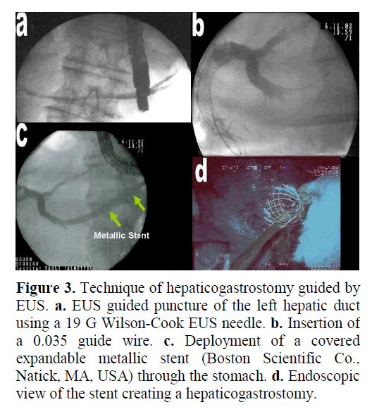 pancreas-technique-hepaticogastrostomy