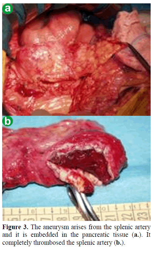 pancreas-the-aneurysm-arises-splenic-artery