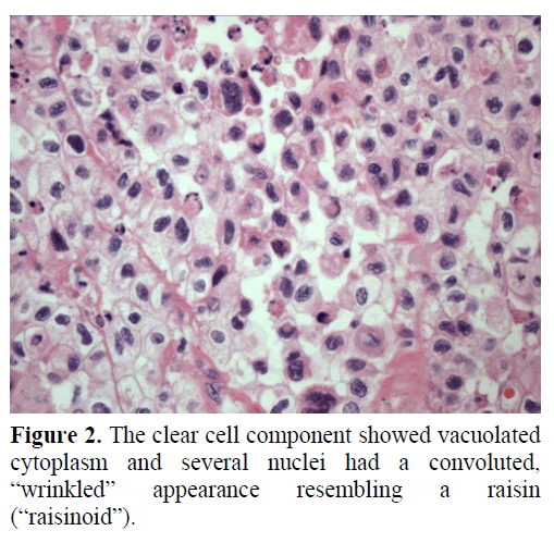 pancreas-the-clear-cell-component