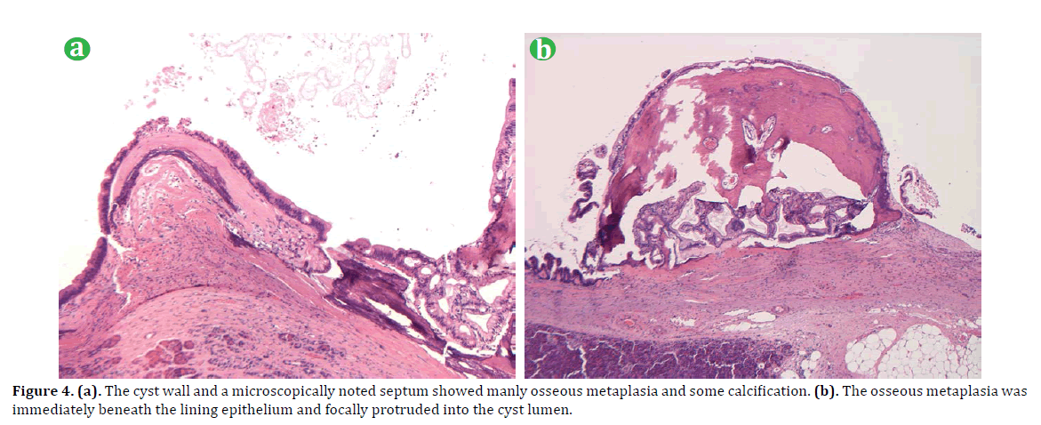 pancreas-the-cyst-wall-microscopically