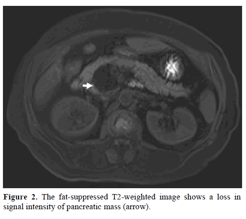 pancreas-the-fat-suppressed-t2-weighted