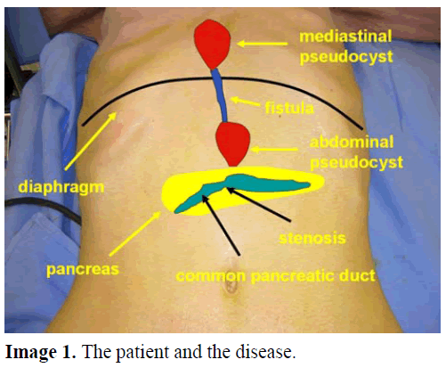 pancreas-the-patient-disease