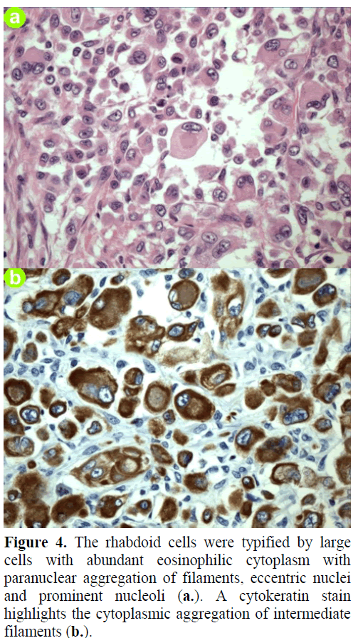 pancreas-the-rhabdoid-cells-typified