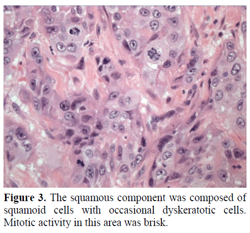 pancreas-the-squamous-component