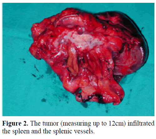 pancreas-the-tumor-infiltrated-spleen