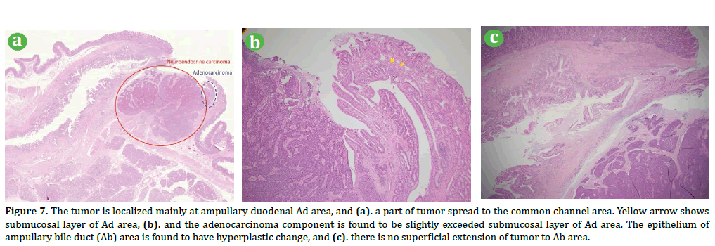 pancreas-the-tumor-localized-ampullary