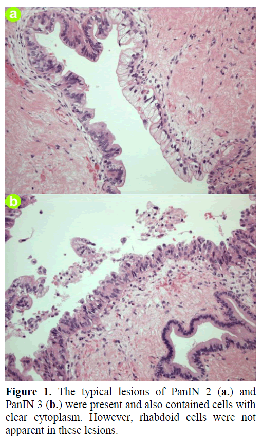 pancreas-the-typical-lesions-panin