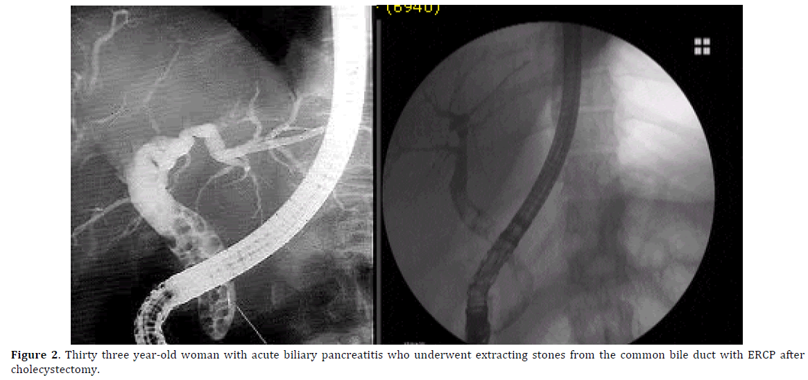 pancreas-thirty-three-year-old