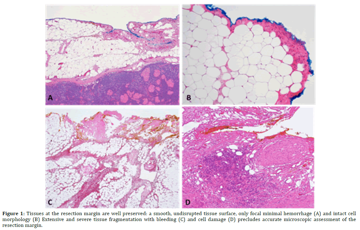 pancreas-tissues-resection-margin