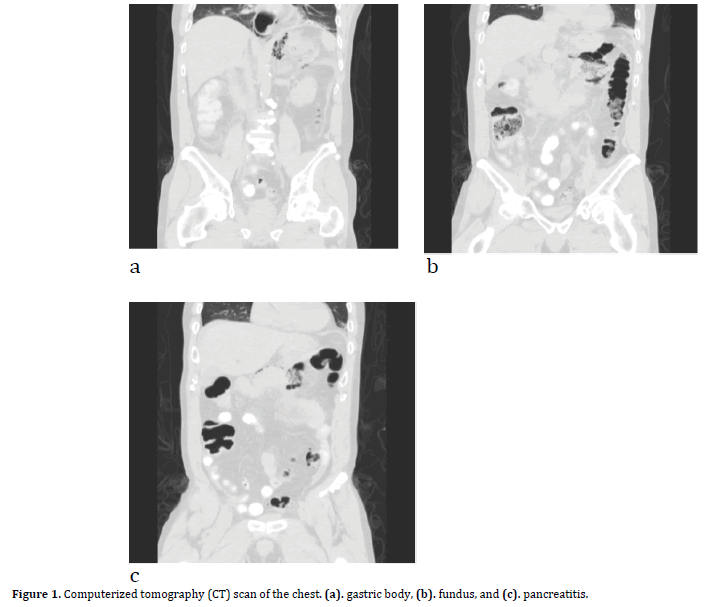 pancreas-tomography