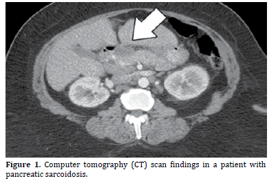 pancreas-tomography