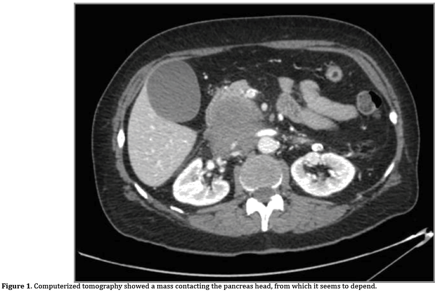 pancreas-tomography