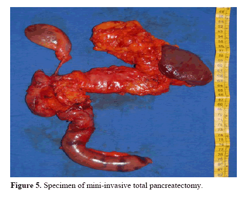 pancreas-total-pancreatectomy