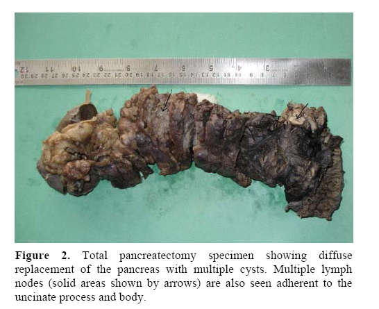 pancreas-total-pancreatectomy-specimen