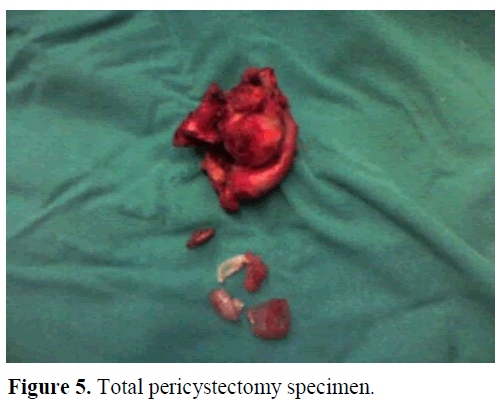 pancreas-total-pericystectomy-specimen