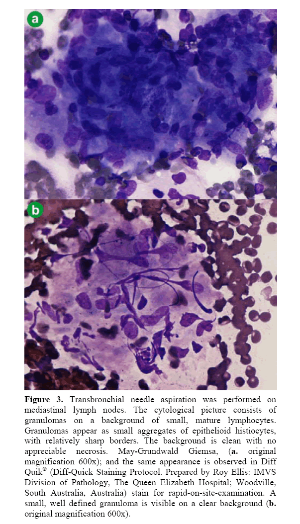 pancreas-transbronchial-needle-aspiration