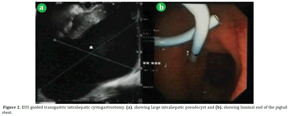 pancreas-transgastric-intrahepatic-cystogastrostomy