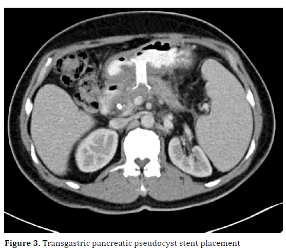 pancreas-transgastric-pancreatic