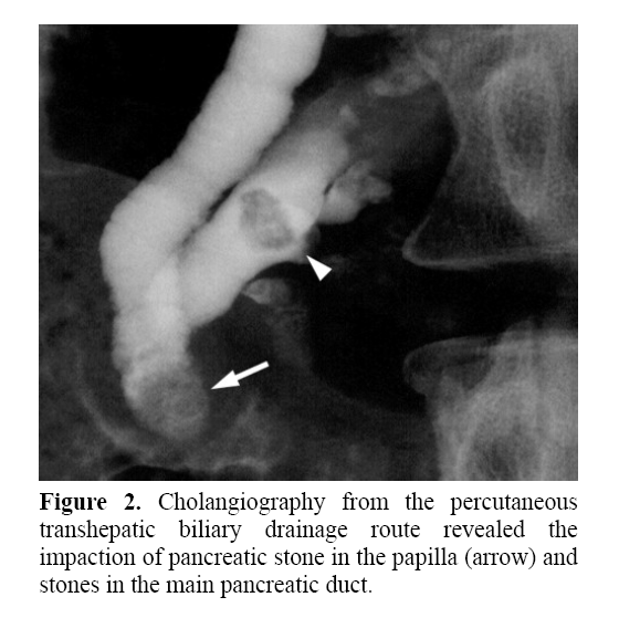 pancreas-transhepatic-biliary-drainage