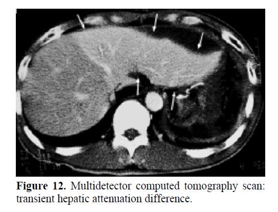 pancreas-transient-hepatic-attenuation