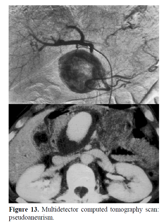 pancreas-transient-pseudoaneurism