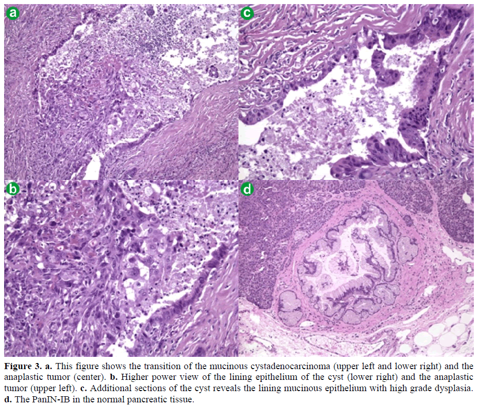 pancreas-transition-cystadenocarcinoma