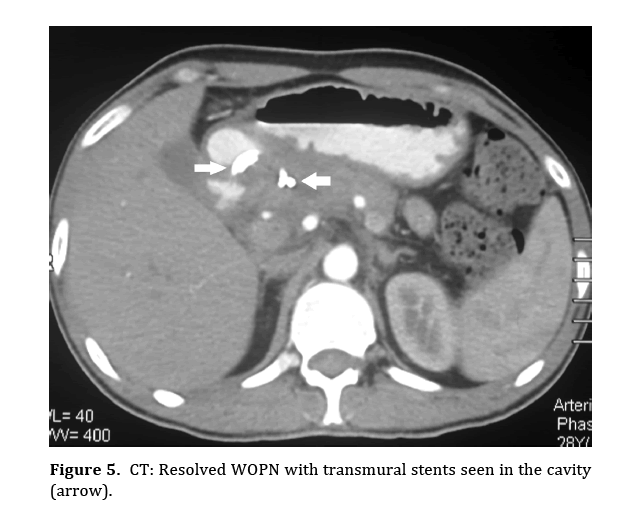 pancreas-transmural-stents-seen